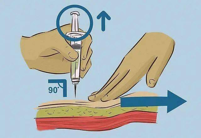 肌肉注射简易图图片