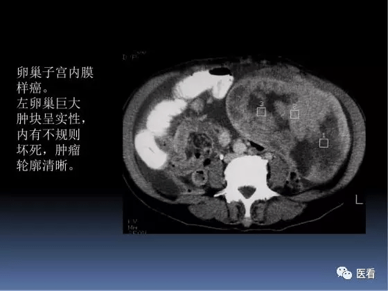 5大卵巢恶性肿瘤如何在ct上寻找蛛丝马迹医学影像经典ppt