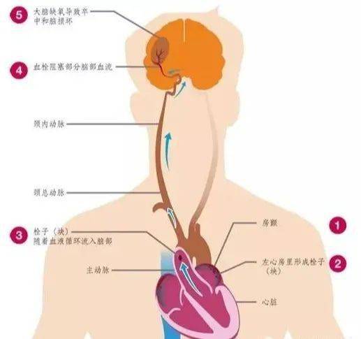 心脏搭脉停博是怎么意思_心脏搭桥是怎么回事