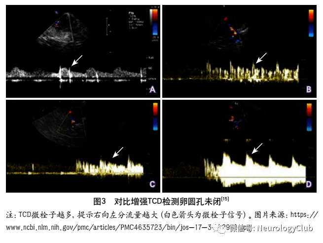 3 经颅多普勒超声发泡试验tcd发泡试验又称为tcd微泡试验或对比增强