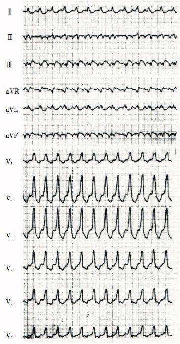 1 例室速患者的心电图表现