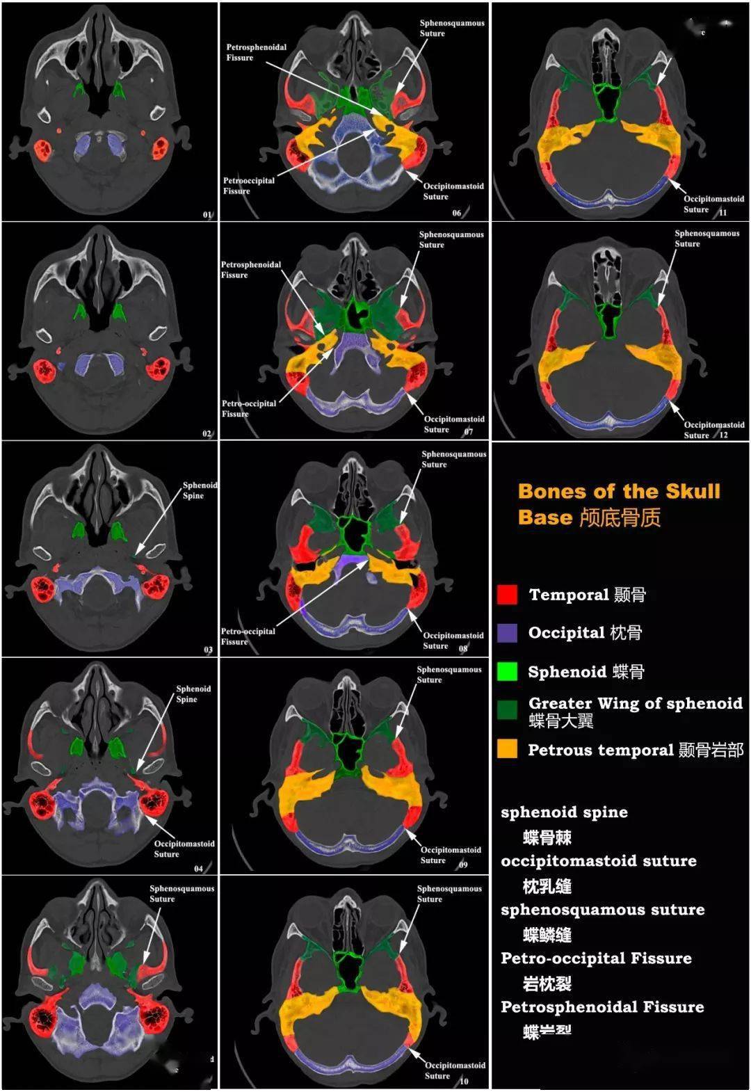 颅底ct高清断层解剖图谱