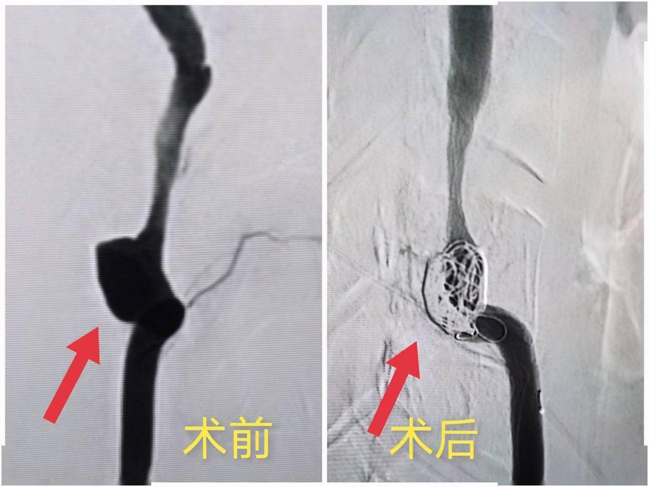 颈动脉瘤支架图片