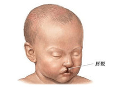 新生儿悬雍垂腭裂图片图片