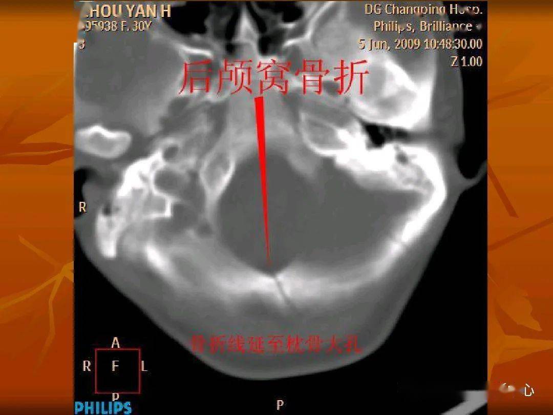 颅底骨断层解剖图ct图片