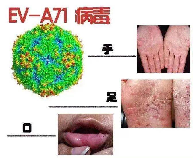 手足口病毒图片大全图片