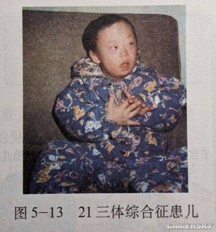 21三体综合症婴儿图片