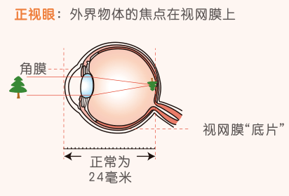 近视镜是运用什么原理_幸福是什么图片