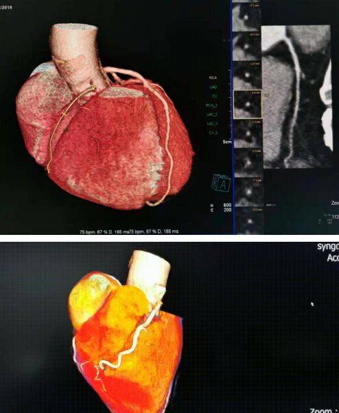 厉害了这项检查居然可以给心脏拍电影