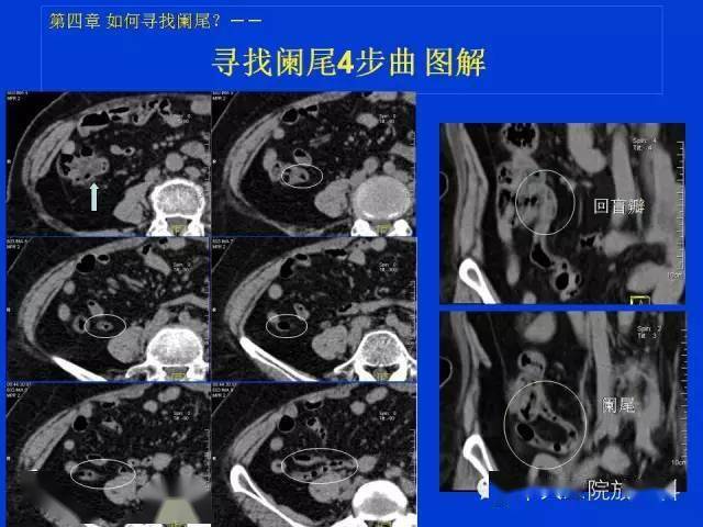 阑尾炎ct怎么看图解图片