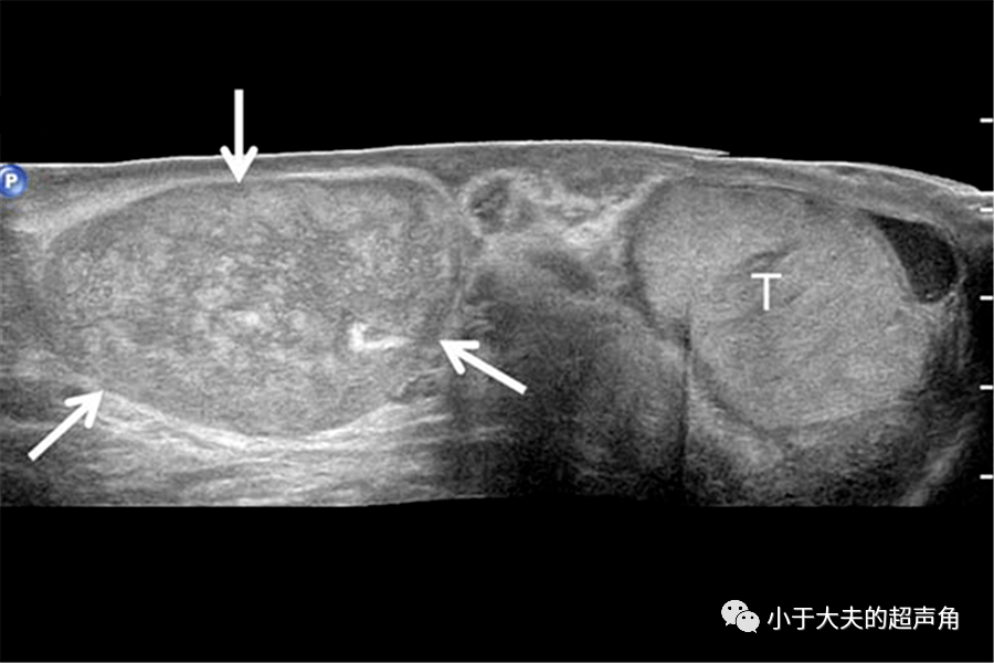 睾丸肿瘤超声图片图片