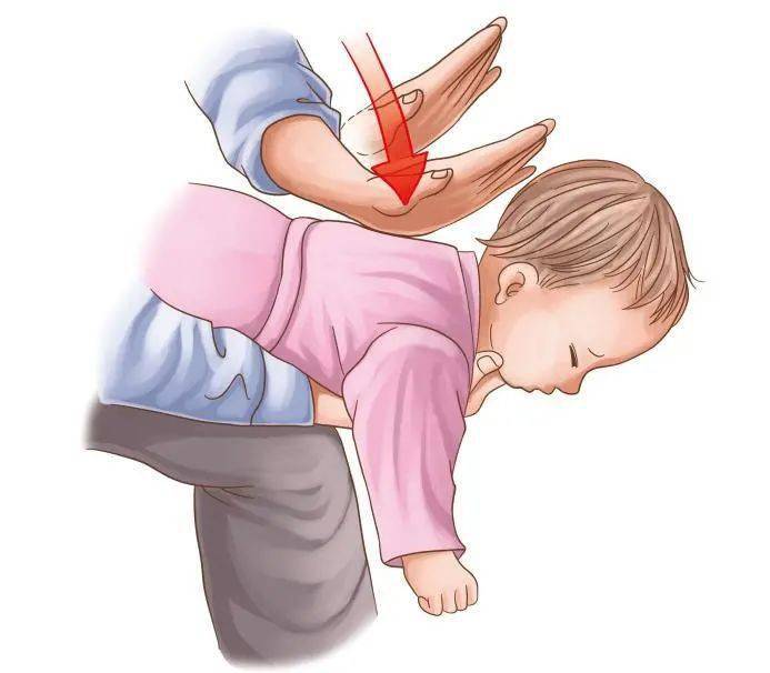 孩子噎食了,赶快拍背