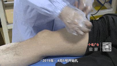 市人民医院针灸科主任 杨琼玉:每个人肯定是不一样的,有的人(疗效)