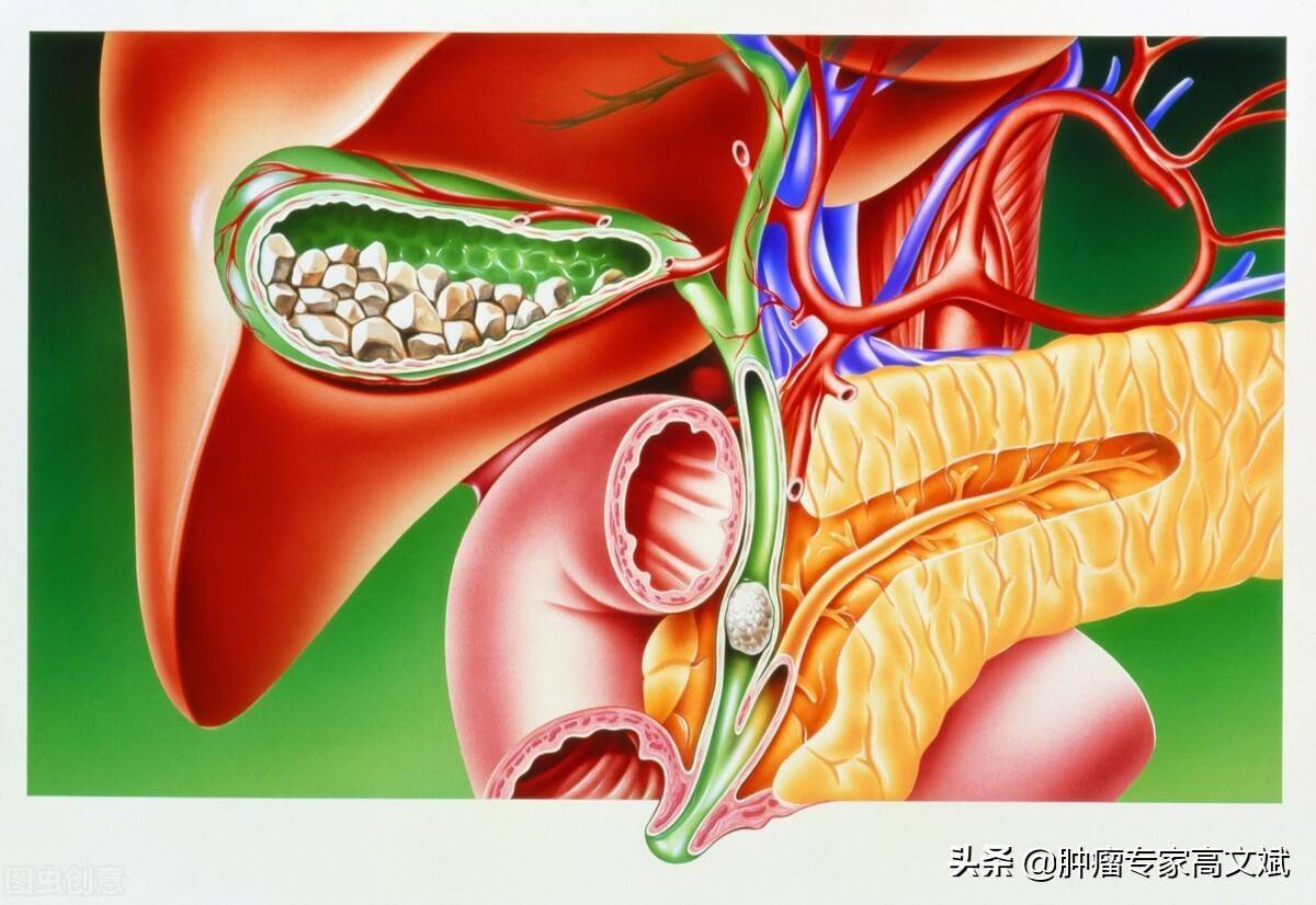 或者肝臟轉移腫瘤等各種原因導致的人體肝臟,膽管系統的梗阻