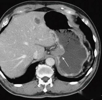 见惯胃腺癌这8种胃肿瘤ct表现你了解多少