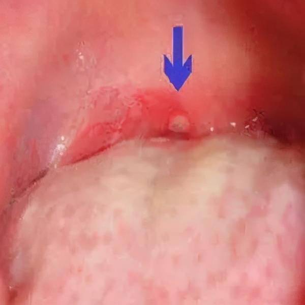 小孩喉咙长疱疹图片图片