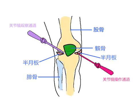 半月板损伤 中医疗法 了解一下 膝关节