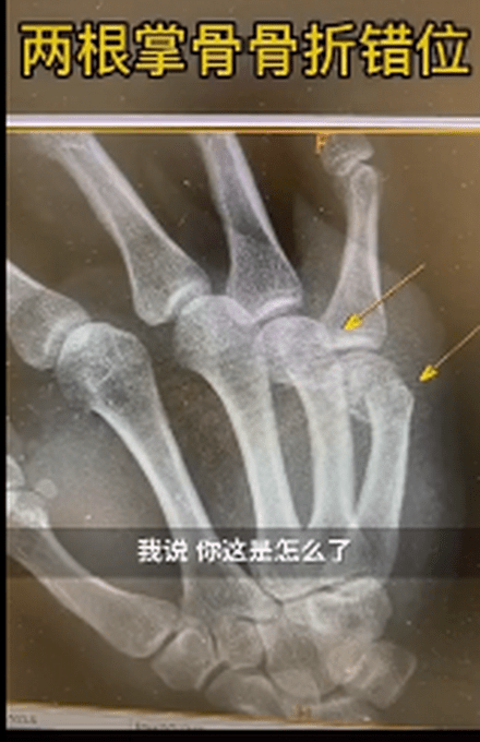 父亲辅导作业捶墙致手骨折!