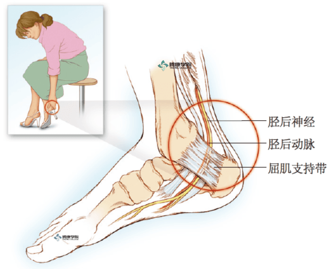 常见周围神经卡压综合征