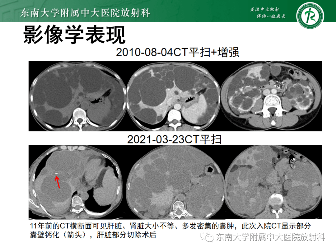 晨读结果公布20210416消化系统疾病caroli病