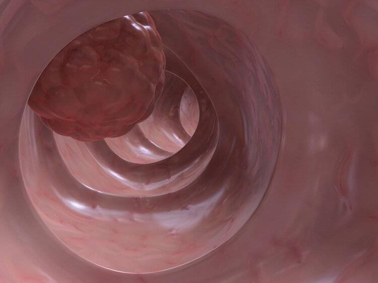 大便带血是肠癌还是痔疮3个症状合并出现你该警惕了