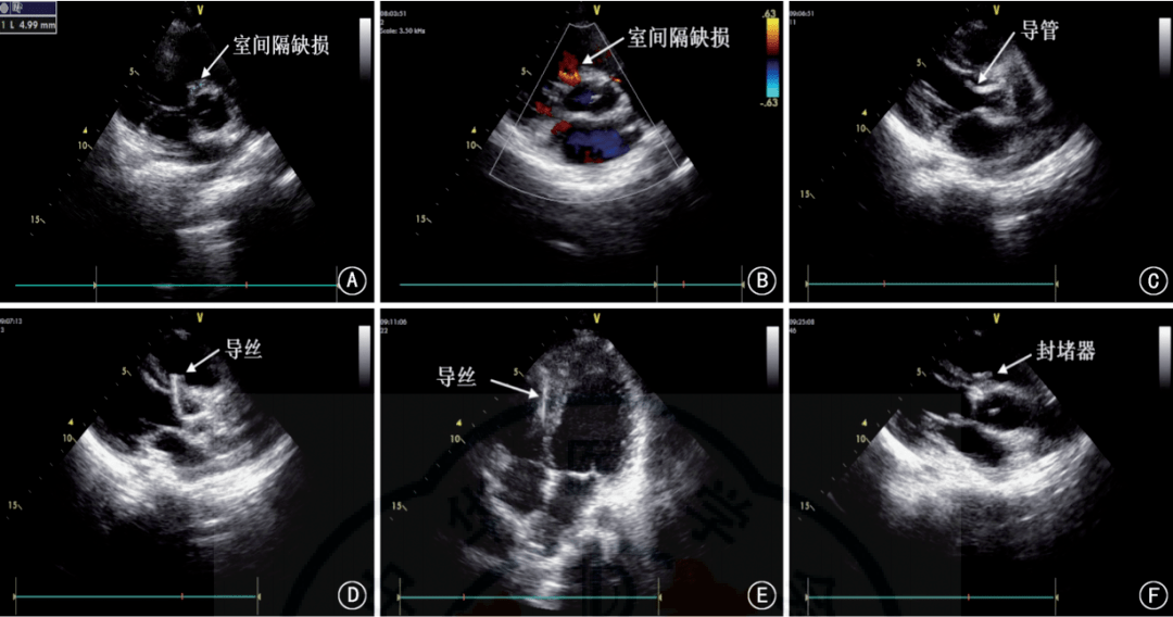 室间隔缺损超声图解图片