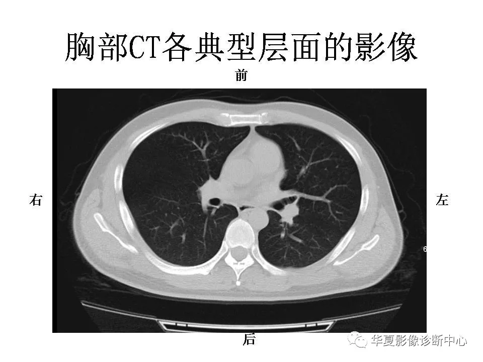 汇总胸部ct读片扫盲知识看懂胸部ct不再难