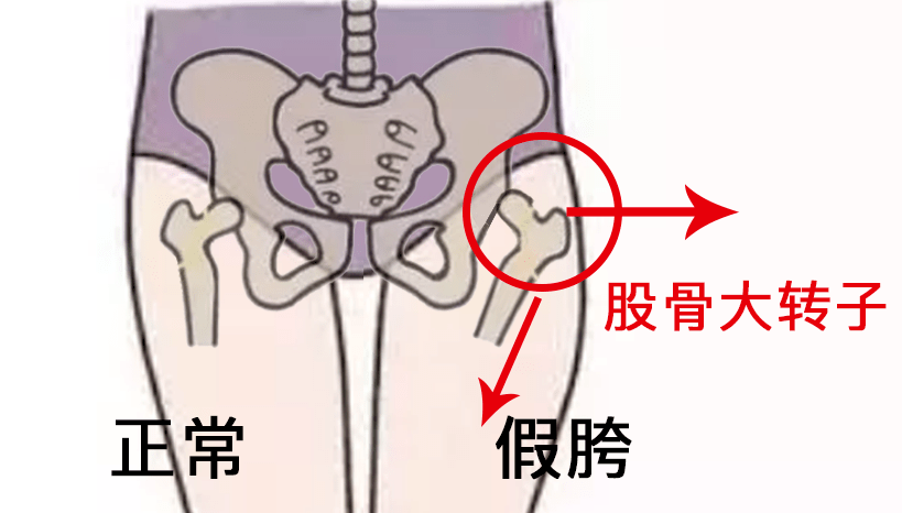 在下肢承重情况下