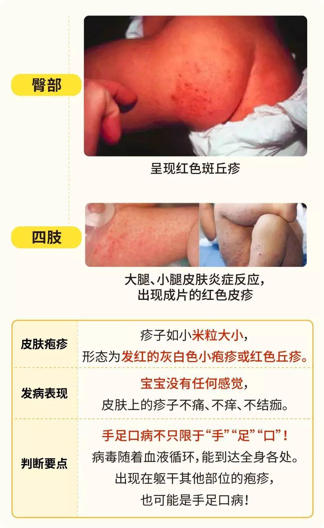 儿童疱疹是怎么引起的图片