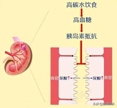 降尿酸最有效的方法:7個減法,3個加法