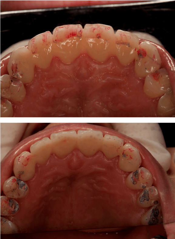 慢性牙周炎患者牙周序列治疗联合修复治疗1例