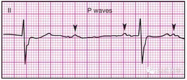 最全面的異常心電參考圖,建議收藏!_心電圖