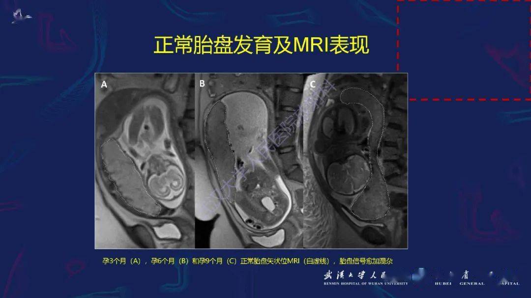 什么叫植入性胎盘 7f942a1b9eaf4f8cb74983c5ff4205ab.jpeg