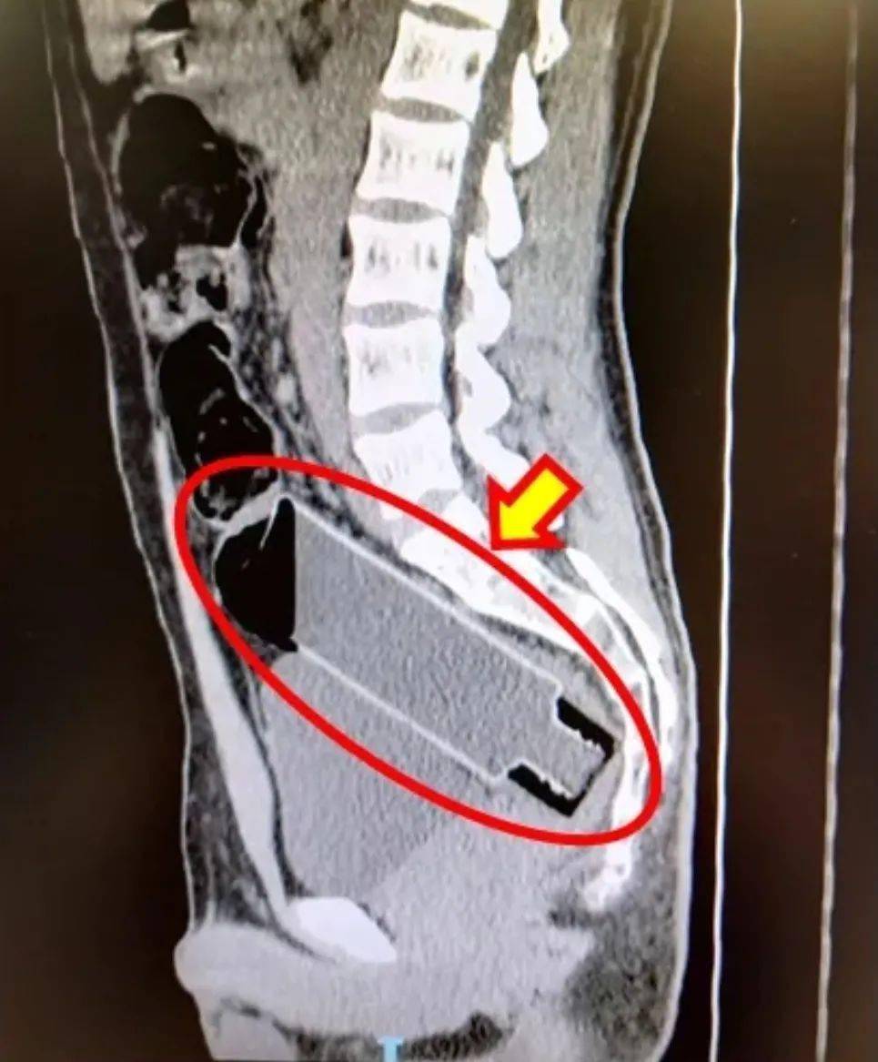 肛门异物怎么取出来图片