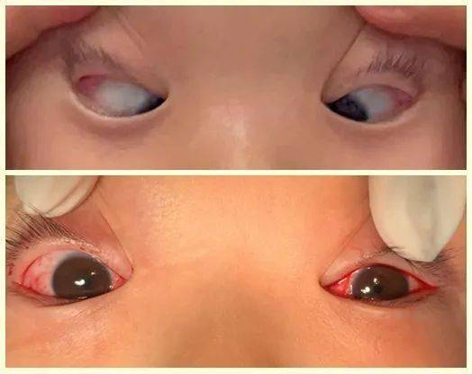 斜眶联合柳暗花明丨市眼科医院完成一名先天性眼外肌纤维化患儿的斜视