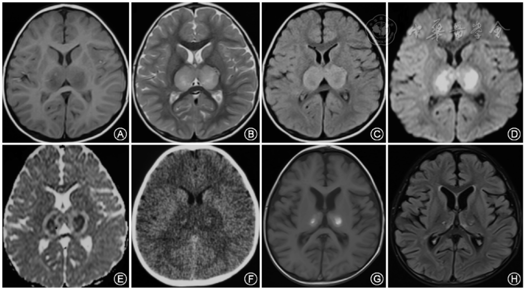 临床研究人类疱疹病毒6型感染所致儿童急性坏死性脑病一例