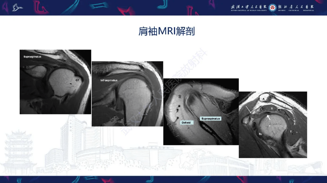 肩關節運動損傷mri診斷