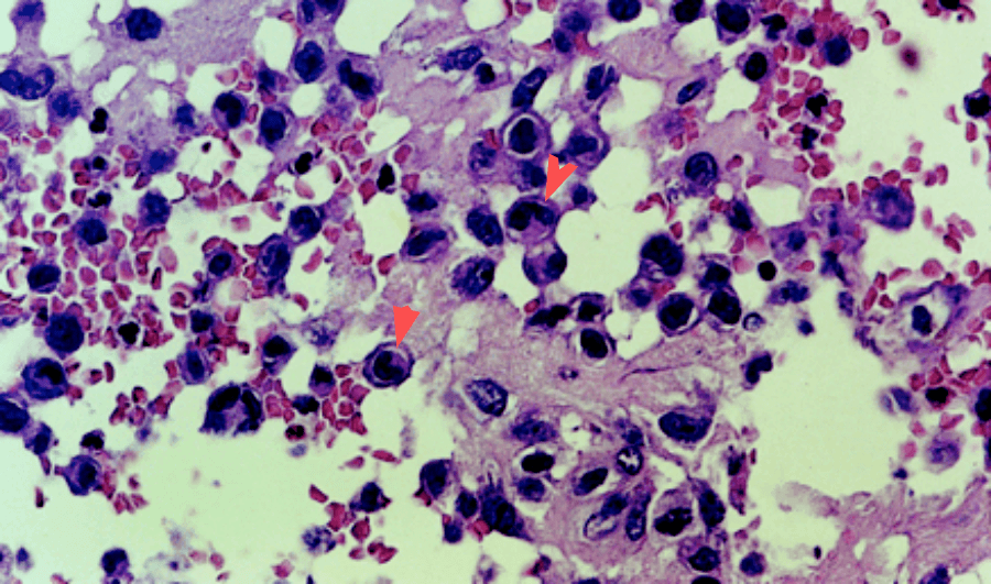 细胞核扭曲变形,细胞质呈嗜酸性 图源:参考文献 1问颅骨溶骨性病变