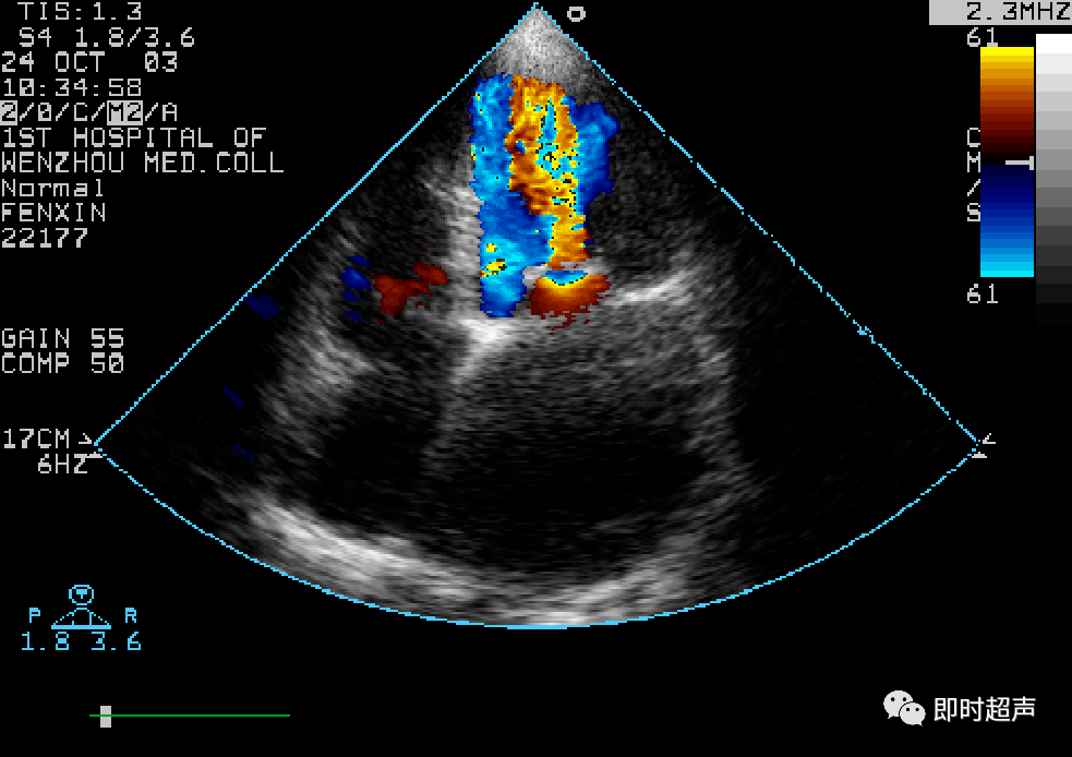 心脏瓣膜病超声诊断_二尖瓣