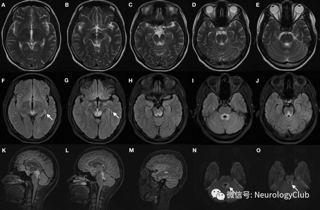 动眼神经mri影像解剖图图片