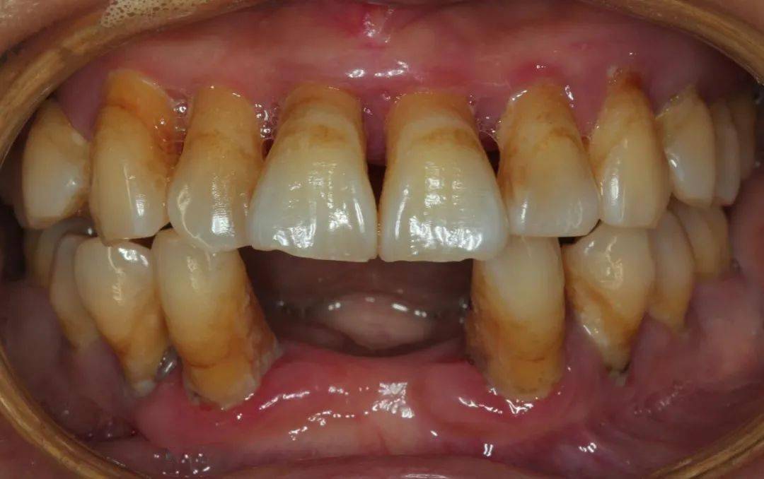 应用全程数字化对重度牙周炎患者实现即刻种植即刻修复一例