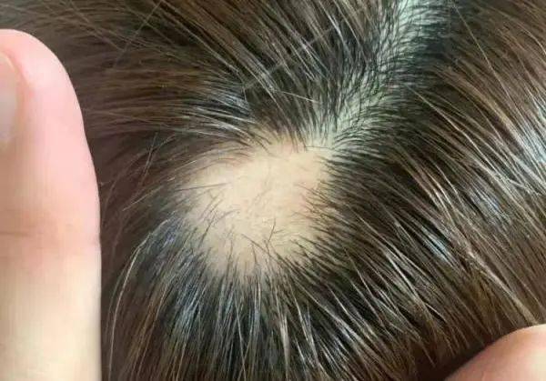 目前我们只知道斑秃是一种常见的自身免疫性疾病,当白细胞攻击毛囊中