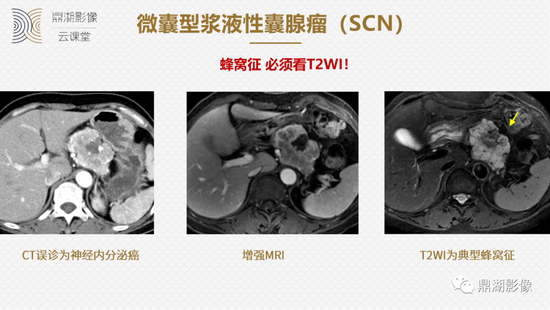 速記!十五大影像特徵與胰腺病變