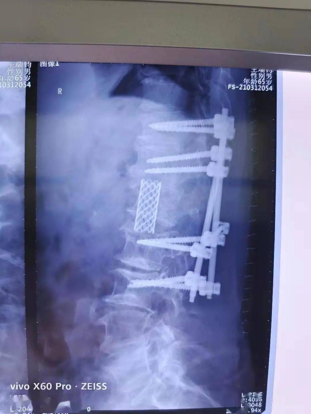 骑个自行车脊椎骨折了……多项技术联合奇迹修复!_脊髓