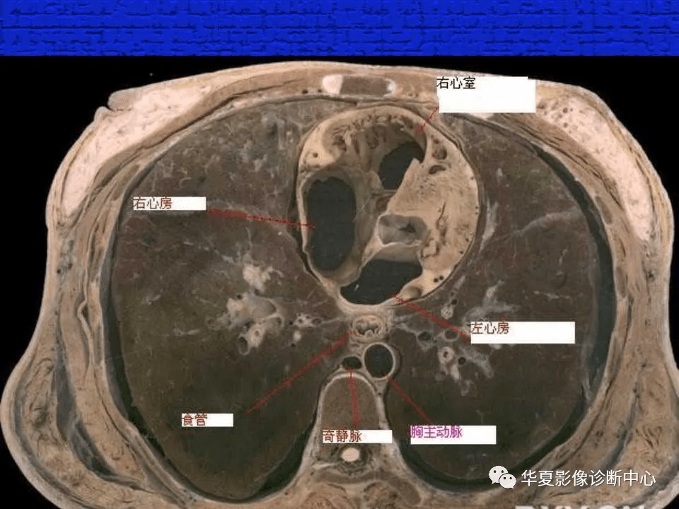 ct入门结合解剖谈正常胸部ct读片