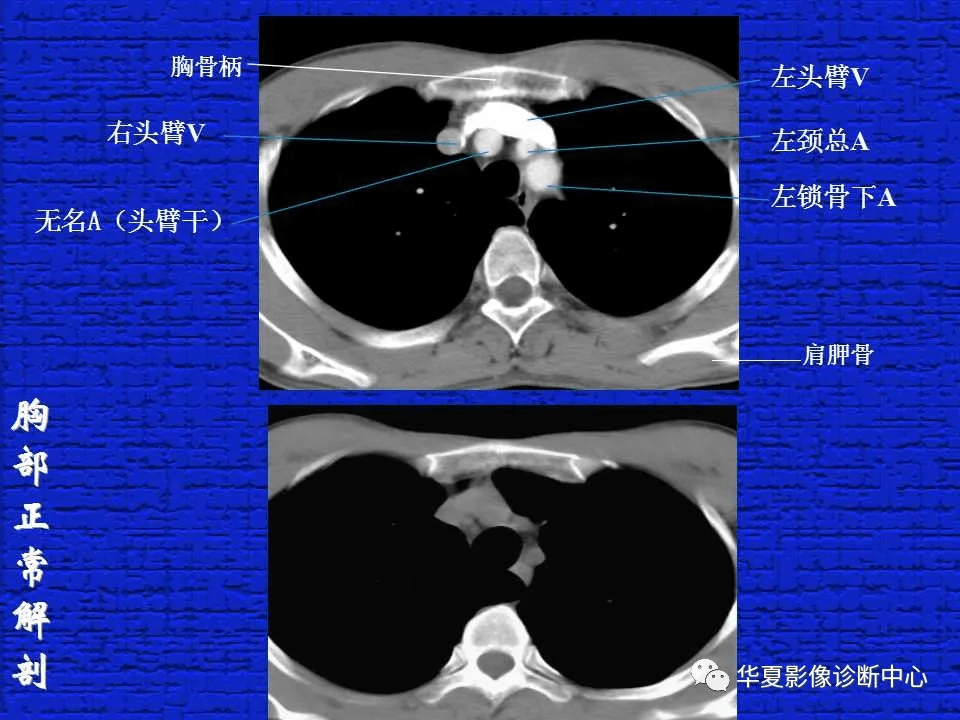 ct入門結合解剖談正常胸部ct讀片