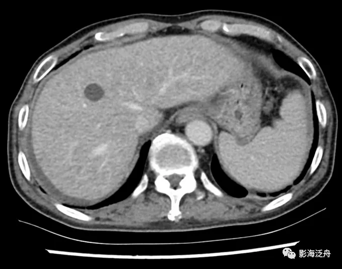胰腺癌术后3月复查,肝周少量积液,增强门脉期肝实质密度略欠均匀,隐约