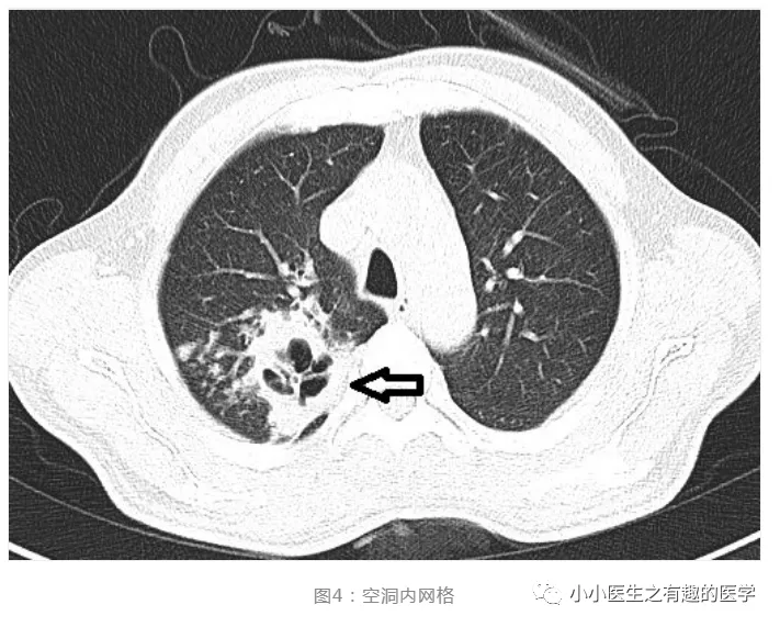 肺空洞血管穿行征或大有用处