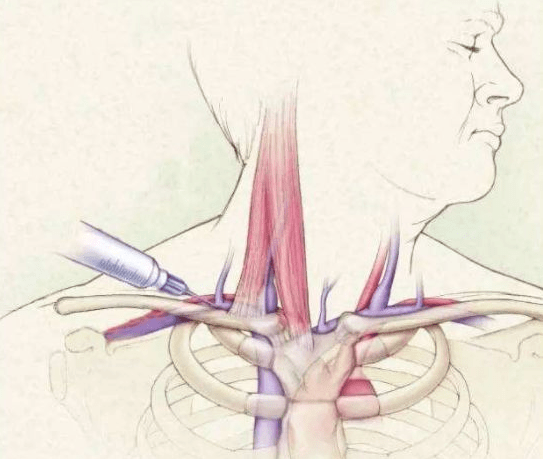 颈外静脉穿刺部位图片