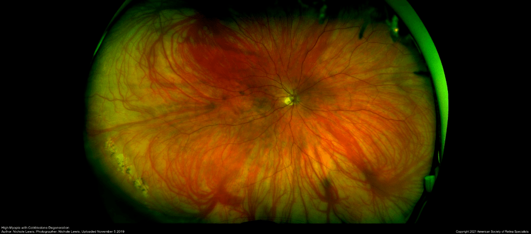 周边视网膜变性图片